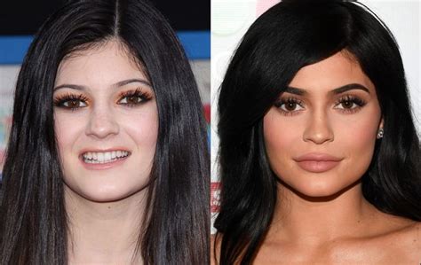May be, may be not! Kylie jenner before after surgery SHIKAKUTORU.INFO
