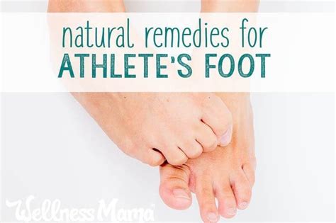 5 Effective Natural Ways To Remedy Athletes Foot For Good In 2020 Athletes Foot Remedies