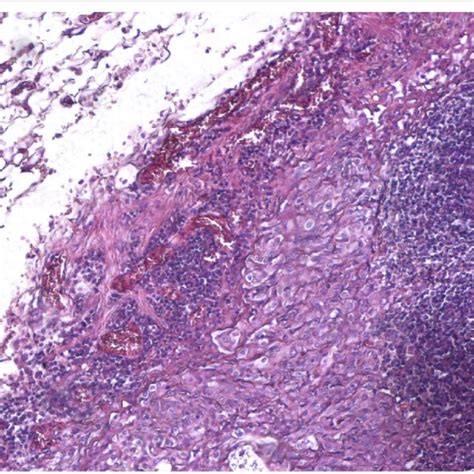 Poorly Differentiated Clear Cell Gastric Squamous Cell Carcinoma