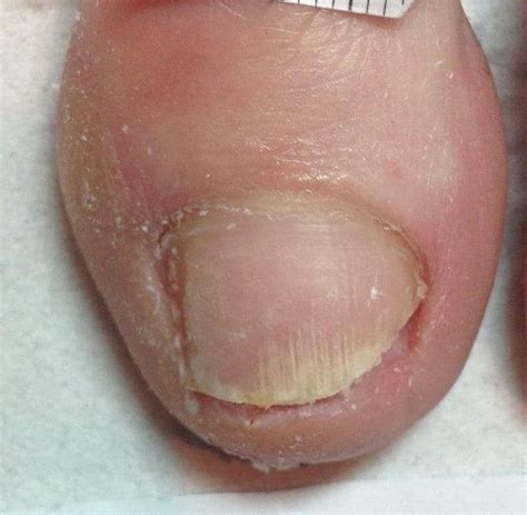 Signs Of Fungal Nail Infection Home Interior Design