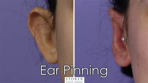 Otoplasty Los Angeles Ear Pinning Plastic Surgery Technique