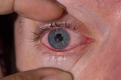 How To Tell If You Have A Scratched Cornea And What To Do Nvision Eye