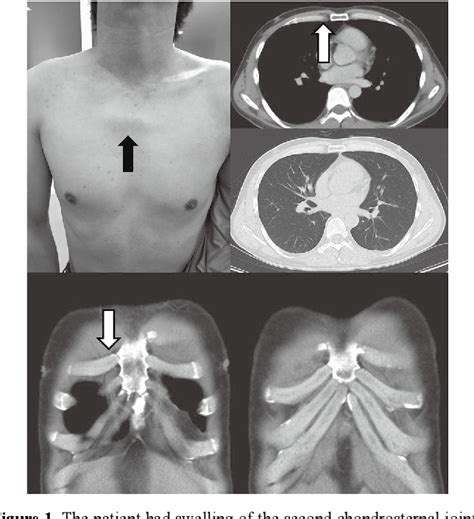 A Patient Presenting Painful Chest Wall Swelling Tietze Syndrome