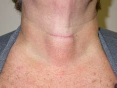 Scar After Parathyroid Surgery Parathyroid Surgery Org