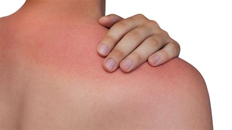 What Is Heat Rash How To Treat It And Prevent It According To A