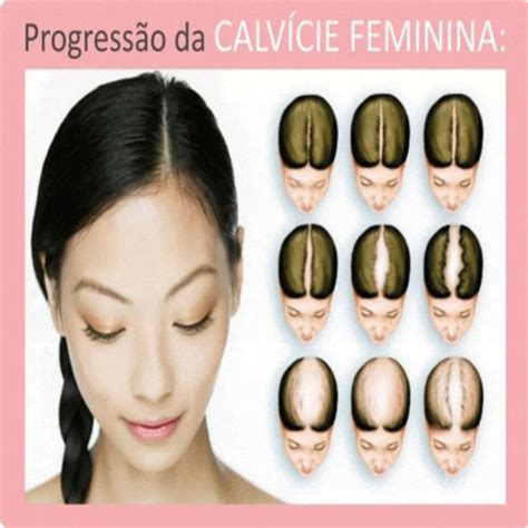 Alopecia Androgenética Tudo Sobre A Calvície Feminina Crescetrat
