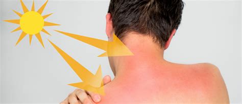 9 home remedies to treat sunburn naturally zameen blog