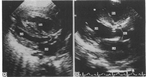 A Parasternal Long Axis View In Systole In A Neonate With Coarctation