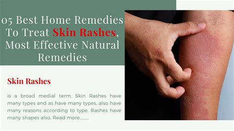 05 Best Home Remedies To Treat Skin Rashes Most Effective Natural Remedies