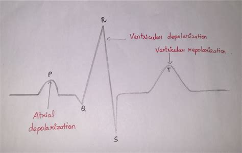 Solved What Is Atrial Depolarization Ventricular Depolarization
