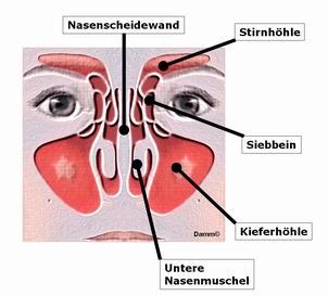 Die entzündete nase im inneren ist als sinusitis bekannt, die nichts anderes als die entzündung der schleimhaut der nasennebenhöhlen ist. HNO Praxisklinik à Wengen für Ohren-, Nasen- und ...