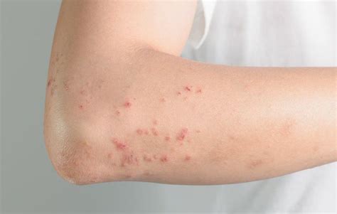 7 Reasons Why You Might Be Breaking Out In Hives Skin Allergies