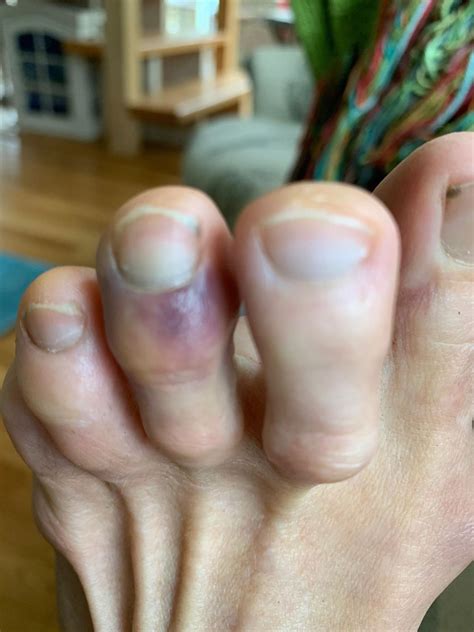 How Do I Know If My Toe Is Broken Or Just Bruised 325511 How Do I Know