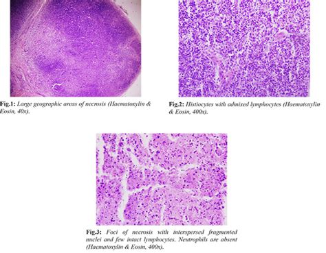 Kikuchi Fujimoto Disease A Rare Cause Of Lymphadenopathy