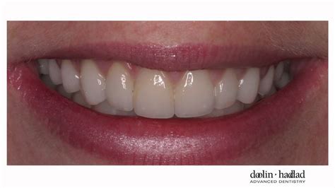 They will actually look extremely natural! "My porcelain veneers are so natural looking...I love them ...