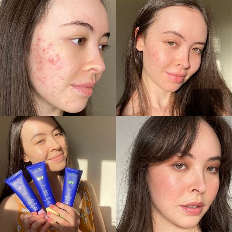 Perfectly Imperfect Skin A Journey Of Acne And Self Love By Sunshine