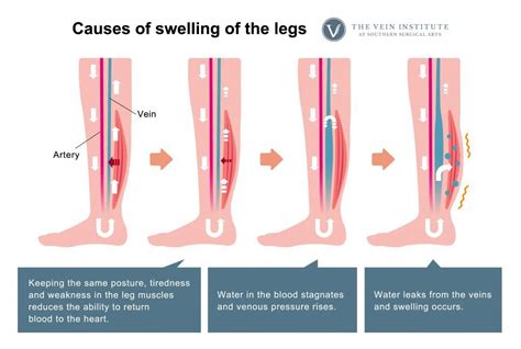 Qanda Is Swelling Related To Vein Health The Vein Institute At Ssa