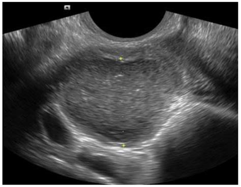 Diagnostics Free Full Text Transvaginal Ultrasound In The Diagnosis And Assessment Of
