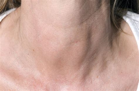 Thyroiditis Swollen Thyroids In Neck Stock Image C0041236