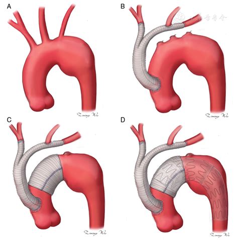 Debranching Thoracic Endovascular Aortic Repair Combined With Ascending