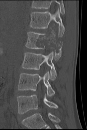 Ct Scan Of The Lumbar Spine Cedars Sinai