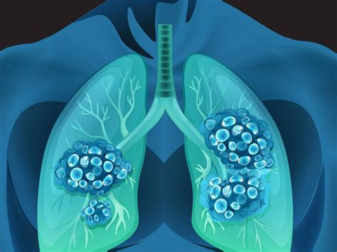 吡咯替尼用于her2并晚期非小细胞肺癌患者的疗效分析医学界 助力医生临床决策和职业成长