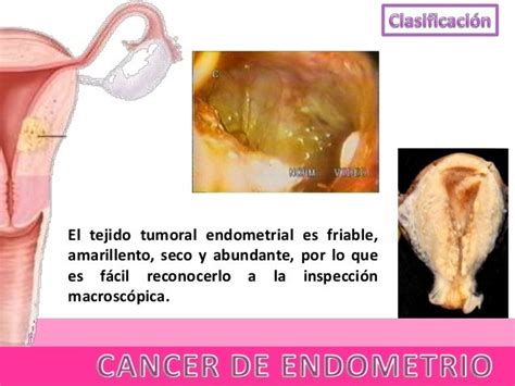 Cancer De Endometrio