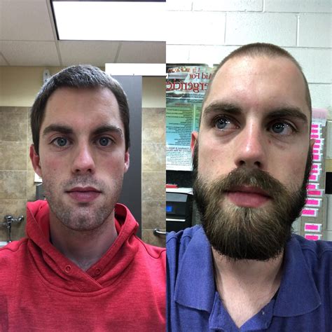 Make sure to apply moisturizer after minoxidil has dried (approximately 4 hours). Minoxidil Beard Reddit Before And After Pictures | Beard Style Corner