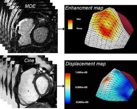 Is Mri The Preferred Method For Evaluating Right Ventricular Size And
