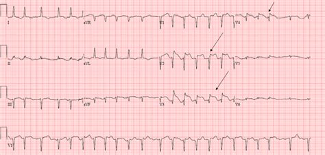 12 Lead Electrocardiogram Showing St Marked Anterior St Elevation