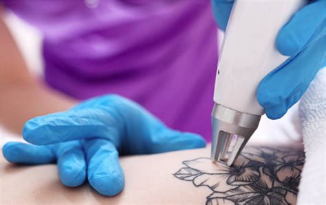 Tattoo Removal Level 5 Course East London Beauty Academy