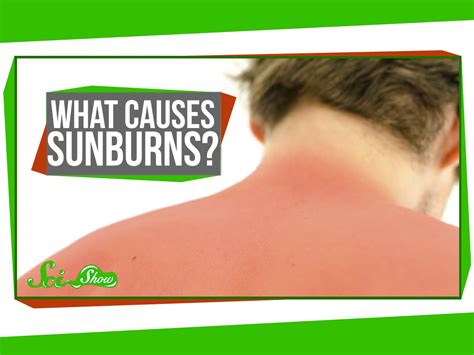 An Quick Explanation Of What Causes Sunburns
