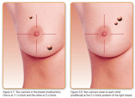What to expect after a mastectomy: Get the Facts - Mastectomy & Reconstruction - Reclaim Your ...