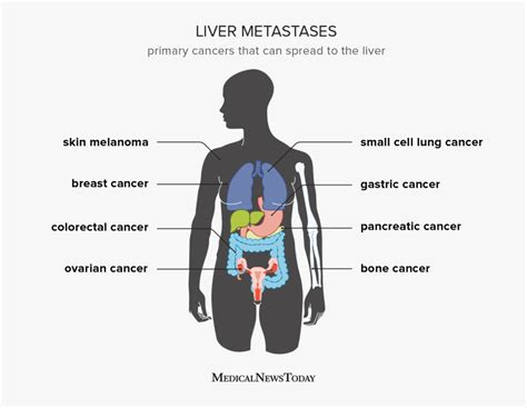 Liver Metastases Symptoms Diagnosis And Outlook