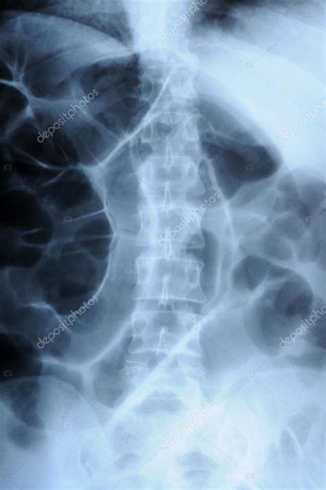 Radiografía De La Columna Vertebral Humana — Foto De Stock © Fotokon