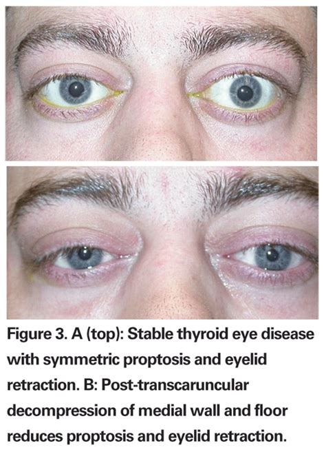 Update On Thyroid Eye Disease