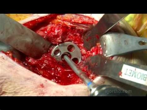 Maybe you would like to learn more about one of these? Shoulder Surgery: Reverse Shoulder Arthroplasty - YouTube