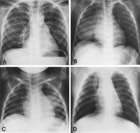 Differentiation Of Bacterial And Viral Pneumonia In Children Thorax