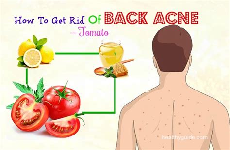 10 Tips How To Get Rid Of Back Acne Spots And Scars Fast Overnight At Home