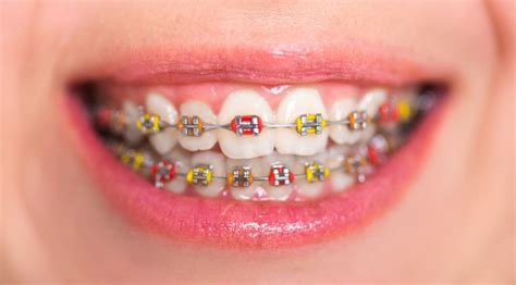 All The Different Braces Colors Warehouse Of Ideas