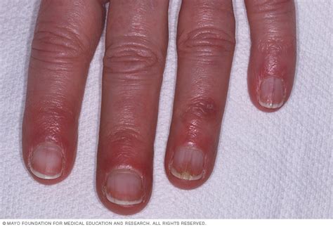 Chilblains Symptoms And Causes Mayo Clinic