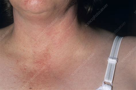 Swollen Lymph Node Stock Image M1310633 Science Photo Library