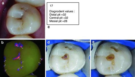 Caries Diagnosis Using Light Fluorescence Devices Vistaproof And