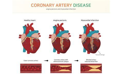 Coronary Artery Disease In El Paso Tx