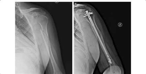 A Radiograph Shows A Spiral Fracture Of Humeral Diaphyseal Segment Ao