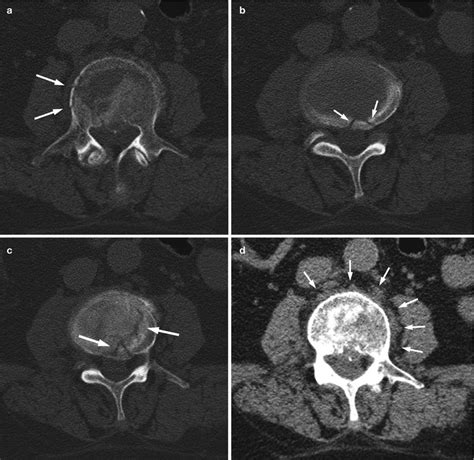 Benign Versus Malignant Vertebral Fractures Radiology Key