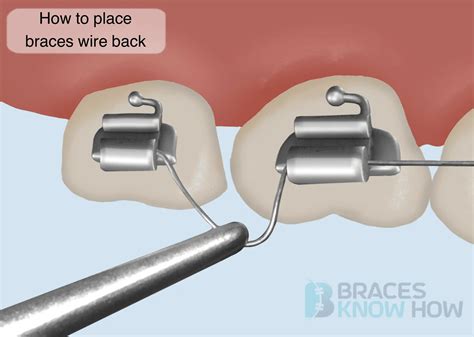 Braces Wire Came Out Of The Back Bracket Here’s What To Do