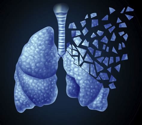 Health Can Lung Cancer Be Cured