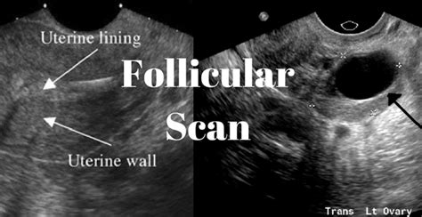 What Follicle Scan Scans For A Complete View On It