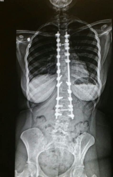 X Ray Of My Spinal Fusion Surgery June 10th 2015 Spinal Fusion Surgery Human Anatomy And